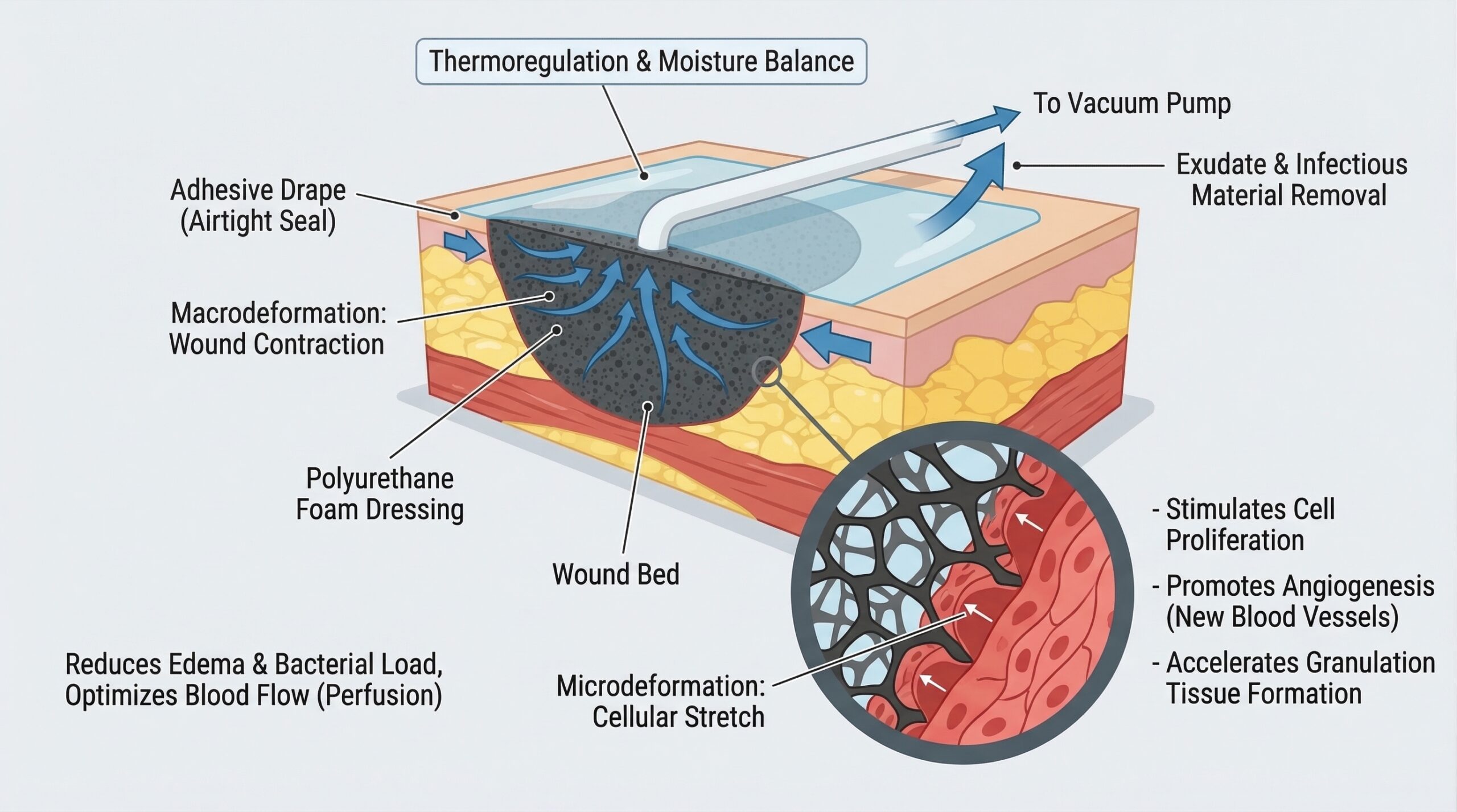 NPWT mechanism of action diagram — showing sealed dressing applying controlled negative pressure to wound bed, removing exudate and promoting granulation tissue formation