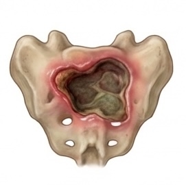 Pressure Ulcer wound care icon