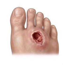 Neuropathic Ulcer wound care icon
