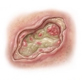 Chronic Wound care icon
